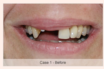 The Dental Implant Procedure