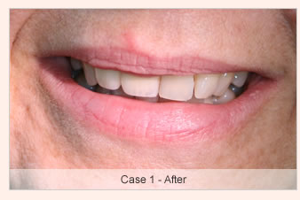 The Dental Implant Procedure