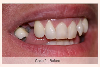 The Dental Implant Procedure