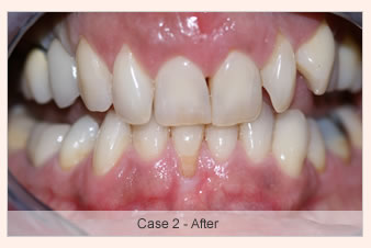 The Dental Implant Procedure