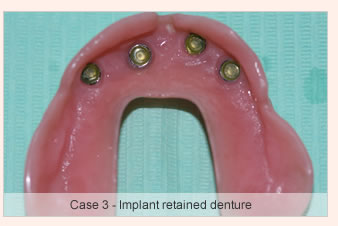 The Dental Implant Procedure