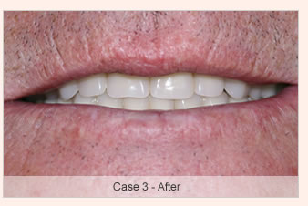 The Dental Implant Procedure